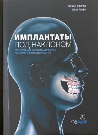 Импланты под наклоном. Протезирование с опорой на импланты при выраженной атрофии челюстей